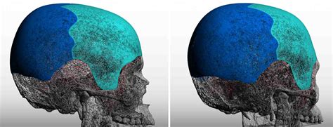 Design Considerations Ofor A Total Custom Skull Implant For Head