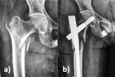 Pfna2 With Intraoperative Complication Of Subtrochanteric Fracture A