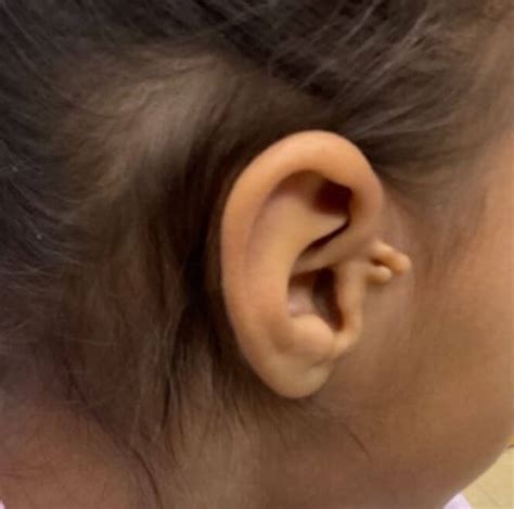 Dermdx Growth On Ear Clinical Advisor