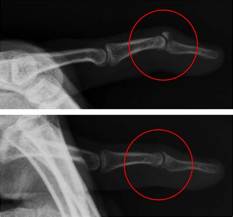 Mallet Finger Raleigh Hand Surgery — Joseph J Schreiber Md