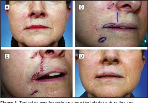 Pdf Outcomes Following V Y Advancement Flap Reconstruction Of Large