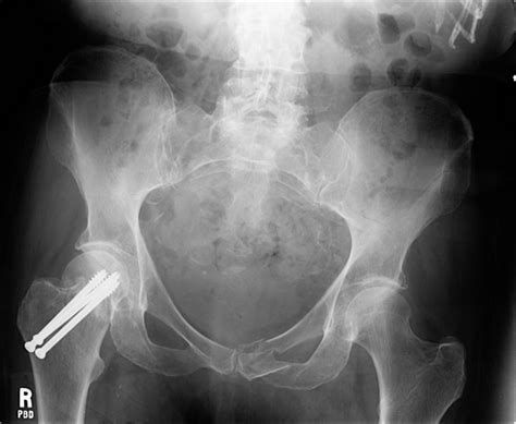 Ortho Dx Pelvic Bone Fracture After A Fall Clinical Advisor