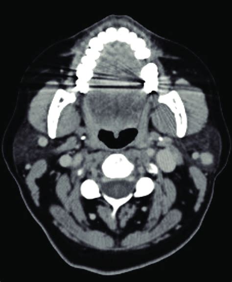 Cect Shows A Rounded Lesion At The Level Of Left Parotid Gland With