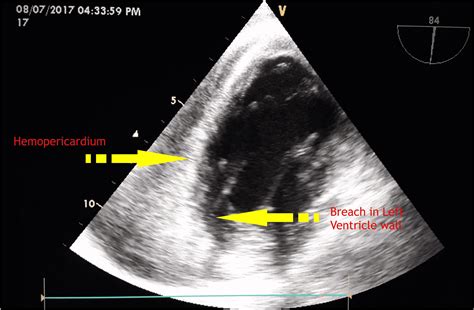 Cureus Perioperative Management Of A Patient With Left Ventricular