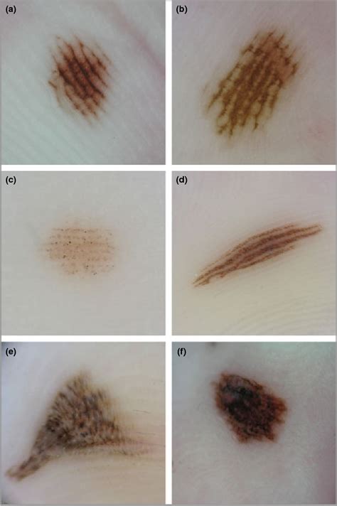 Dermoscopic Features And Follow Up Changes Of Acral Melanocytic Naevi