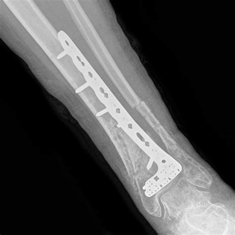 Lower Limb Fractures