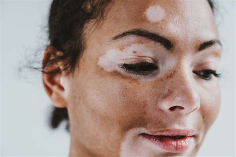 Is Vitiligo Genetic Time To Know More Women Fitness Org