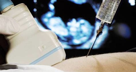 A Amniocentese é Um Método Invasivo Difundido No Diagnóstico Pré-natal