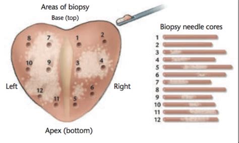 Prostate Biopsy Diagram