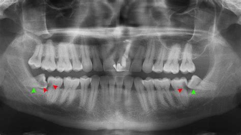 Abscessed Wisdom Tooth Xray