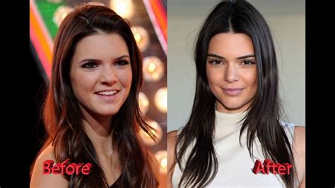 Kendall Jenner Plastic Surgery Before And After Youtube