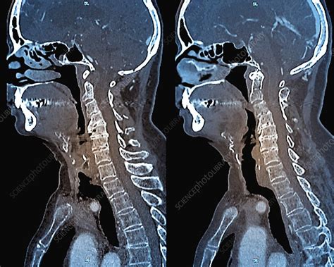 Osteoarthritis Of The Neck Ct Scans Stock Image C0239737
