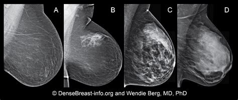 5 Things You Must Know About Dense Breasts Before Your Mammogram Dmc