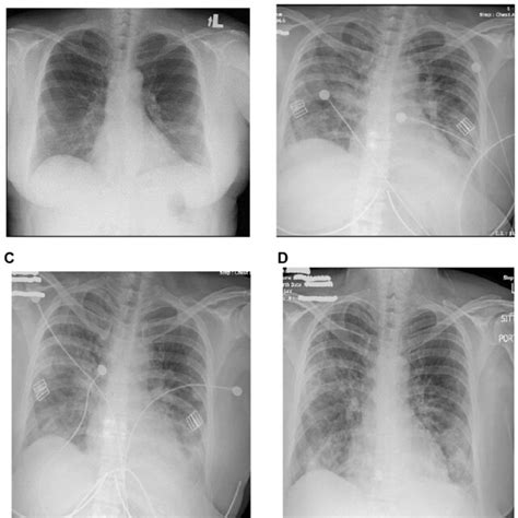 Chest X Ray Findings During Hospitalization Course A Day 1