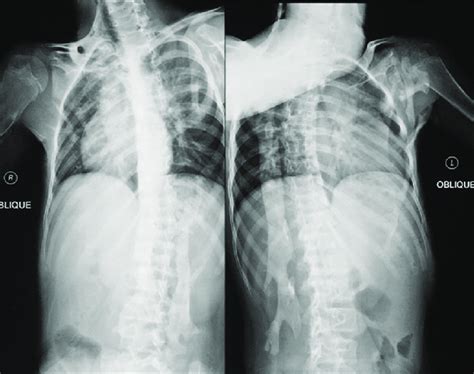 Anteroposterior Radiograph Of The Spine Showing The Right Sided