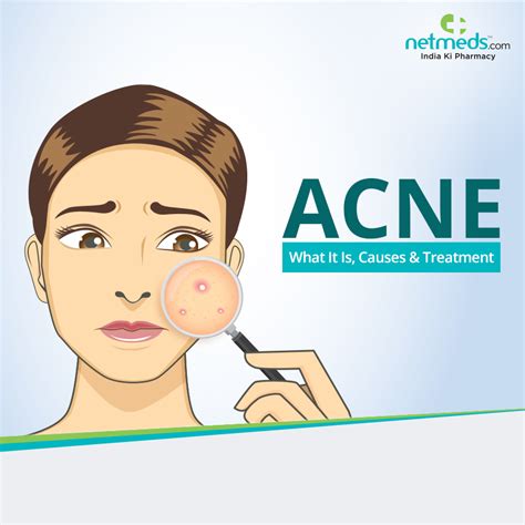 Acne What It Is Causes And Treatment