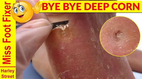 Satisfying Deep Callus And Corn Removal By Miss Foot Fixer Part Youtube