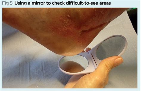 Pressure Ulcer Education 3 Skin Assessment And Care Nursing Times