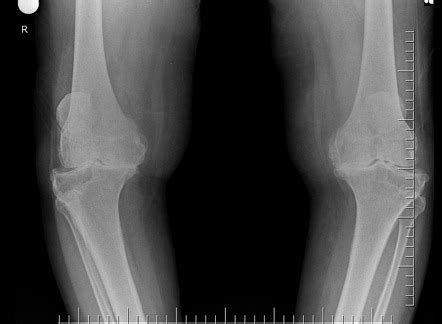 Ahlb Ck Classification Of Knee Osteoarthritis Radiology Reference Article Radiopaedia Org