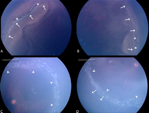 Neurotrophic Keratopathy Following Laser Retinopexy For High Myopia In