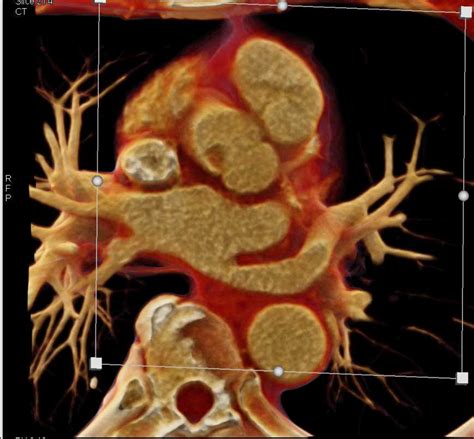 Papillary Fibroelastoma Off Aortic Valve Cardiac Case Studies