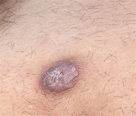Does This Look Like Skin Cancer Dermatology Forums Patient