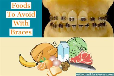 Foods To Avoid With Braces With Lists And Alternatives Orthodontic Braces Care