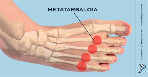 Causes And Symptoms Of Metatarsalgia Mass4d Insoles Mass4d Foot