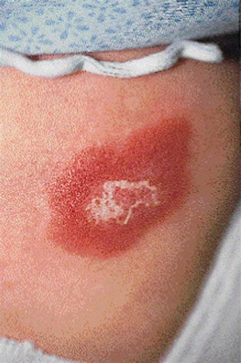 Atypical Forms Of Herpes Simplexassociated Erythema Multiforme