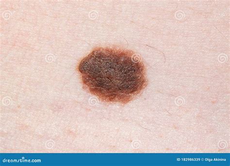 Big Brown Mole On Human Skin Dermatology Prevention Moles Female Skin