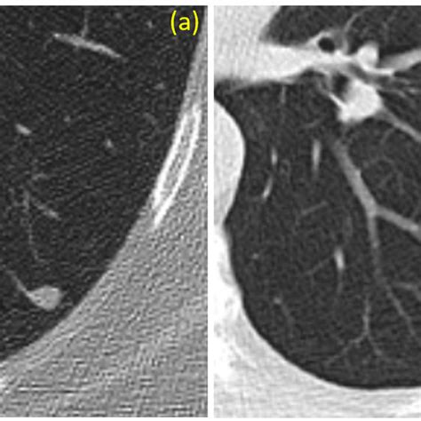 Axial Ct Images Of Two Small Left Lower Lobe Solid Nodules These