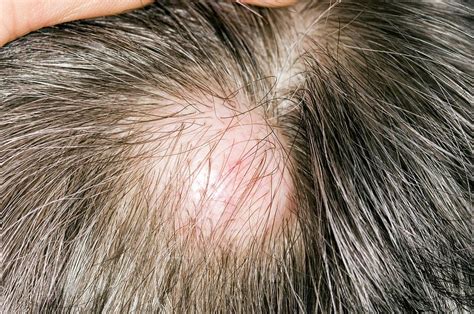 Sebaceous Cyst On The Scalp Photograph By Dr P Marazziscience Photo