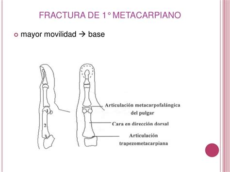 Fractura De 1° Y 5° Metacarpiano