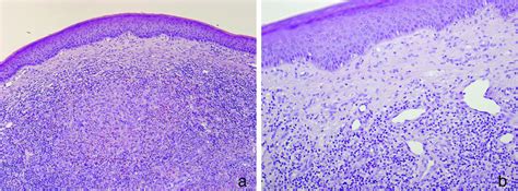 Eosinophilic Dermatoses Peckruhn 2019 Jddg Journal Der Deutschen