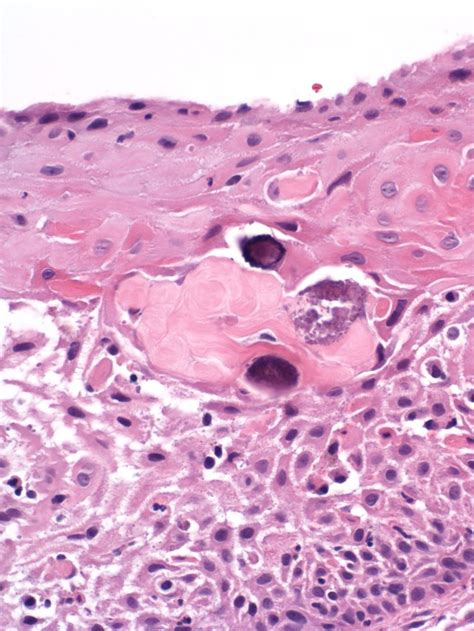 Calcifying Epithelial Odontogenic Tumor Histology