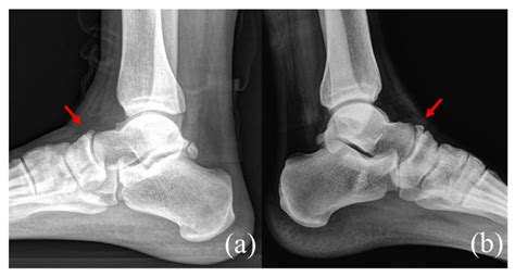 Medicina Free Full Text Treatment Of Navicular Stress Fracture