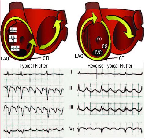 Mechanism And Electrocardiographic Pattern Of Typical Atrial Flutter Download Scientific