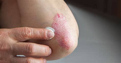 Psoriasis Effect On The Skin The Toll Psoriasis Takes On The Skin