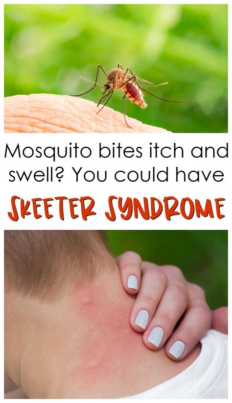 Why Do My Mosquito Bites Sting And Swell Crafty Morning Mosquito