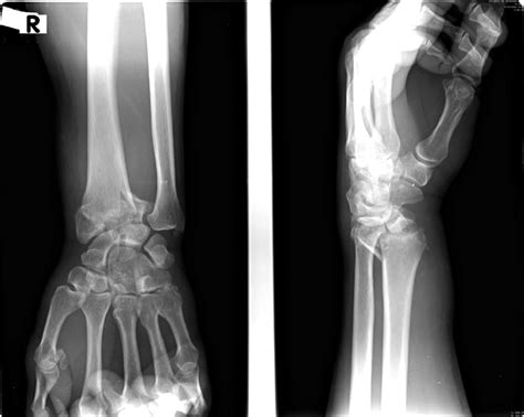Right Wrist Radiographs Showing A Displaced Intra Articular Fracture Of