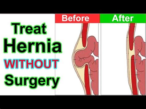 Can You Successfully Treat A Hernia Without Surgery