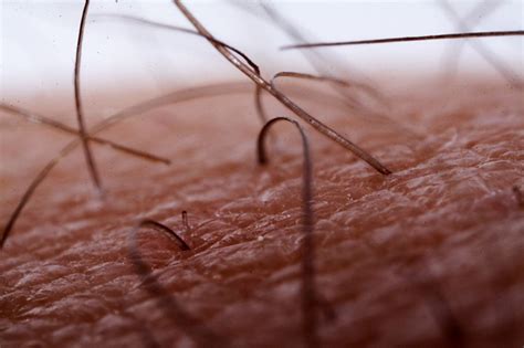 Ingrown Hairs Plague Many Of Us Theyre Those Coarse Hairs That