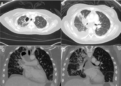 Miliary Tuberculosis In A Paediatric Patient With Psoriasis Bmj Case