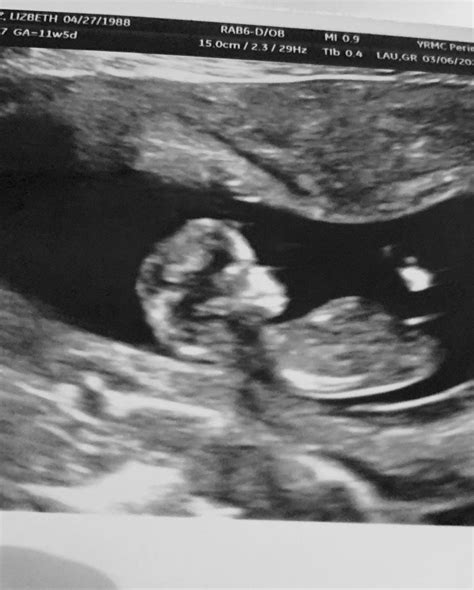 Baby Ultrasound Pictures 12 Weeks Cyndy Kimmel