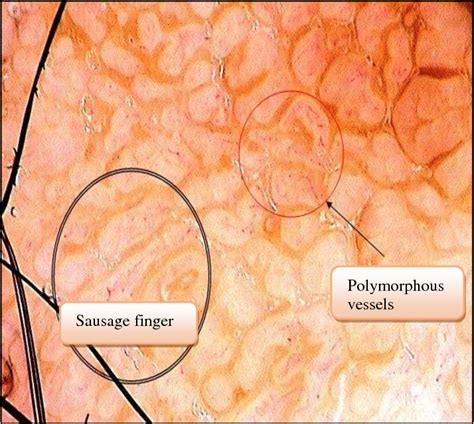 Figure From Dermatoscopic Findings Of Seborrheic Keratosis In Hot Sex Picture