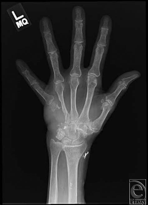 Preoperative Radiograph Demonstrates A Large Hypothenar Soft Tissue