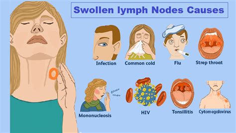Swollen Lymph Nodes Symptoms And Causes Mayo Clinic My Xxx Hot Girl