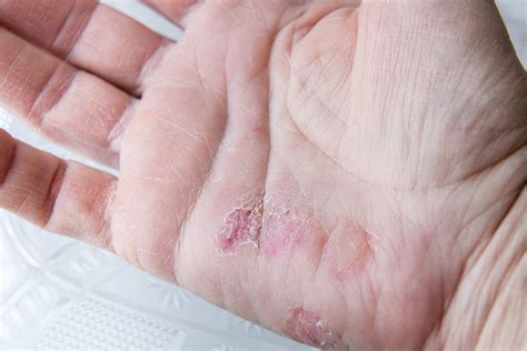 Psoriasis On Hands And Feet