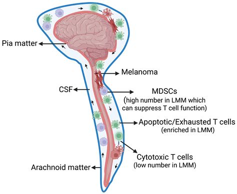 Cancers Free Full Text Leptomeningeal Disease Lmd In Patients With Melanoma Metastases