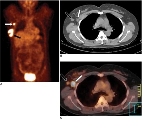 Axillary Lymph Node Metastasis In A 45 Year Old Woman W Open I